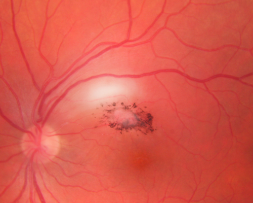 Toxoplasmosis - Inner Retinal - Recurrent - Treated with Bactrim DS 
43-year-old man has macular toxoplasmosis.   He has responded nicely to Bactrim OS:  20/60
Keywords: toxoplasmosis;retinitis;inner retina;recurrent