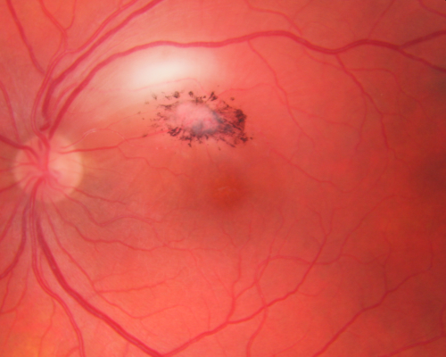 Toxoplasmosis - Inner Retinal - Recurrent - Treated with Bactrim DS 
43-year-old man has macular toxoplasmosis.   He has responded nicely to Bactrim OS:  20/60
Keywords: toxoplasmosis;retinitis;inner retina;recurrent