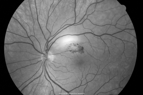 Toxoplasmosis - Inner Retinal - Recurrent - Treated with Bactrim DS 
43-year-old man has macular toxoplasmosis.   He has responded nicely to Bactrim OS:  20/60
Keywords: toxoplasmosis;retinitis;inner retina;recurrent