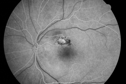 Toxoplasmosis - Inner Retinal - Recurrent - Treated with Bactrim DS 
43-year-old man has macular toxoplasmosis.   He has responded nicely to Bactrim OS:  20/60
Keywords: toxoplasmosis;retinitis;inner retina;recurrent