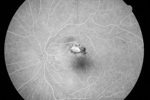 Toxoplasmosis - Inner Retinal - Recurrent - Treated with Bactrim DS 
43-year-old man has macular toxoplasmosis.   He has responded nicely to Bactrim OS:  20/60
Keywords: toxoplasmosis;retinitis;inner retina;recurrent