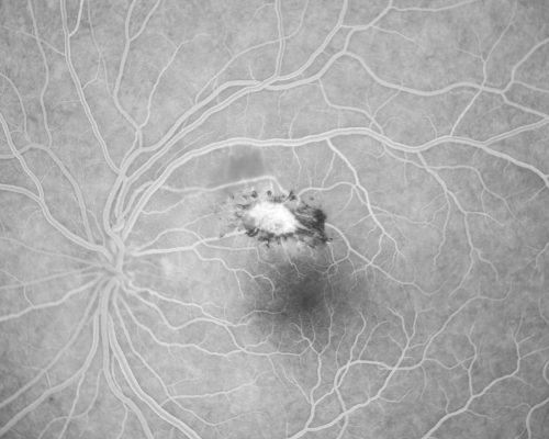 Toxoplasmosis - Inner Retinal - Recurrent - Treated with Bactrim DS 
43-year-old man has macular toxoplasmosis.   He has responded nicely to Bactrim OS:  20/60
Keywords: toxoplasmosis;retinitis;inner retina;recurrent
