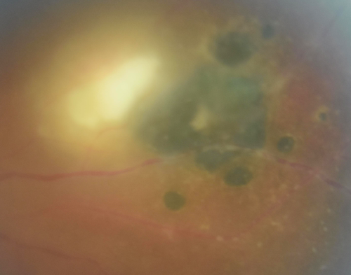 Toxoplasmosis - Recurrent - Moderate Vitritis
32 year old woman with 20/80 vision and moderately painful red eye in the left eye only.  The left eye had some redness about 10 years ago.  She is a native of Sierra Leone
