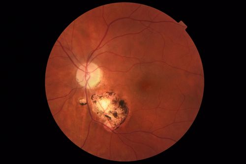 Toxoplasmosis Macular Scar - Inactive
49 year old man Toxoplasmosis was diagnosed in his 20s. No past eye surgeries OU.  He had floaters a few weeks ago with dots and a long line in the vision.  Since then they have gone away.  
VA OD: Dcc20/20 NccJ1+
VA OS: Dcc20/16 NccJ1+
