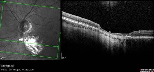 Toxoplasmosis Macular Scar - Inactive
49 year old man Toxoplasmosis was diagnosed in his 20s. No past eye surgeries OU.  He had floaters a few weeks ago with dots and a long line in the vision.  Since then they have gone away.  
VA OD: Dcc20/20 NccJ1+
VA OS: Dcc20/16 NccJ1+
