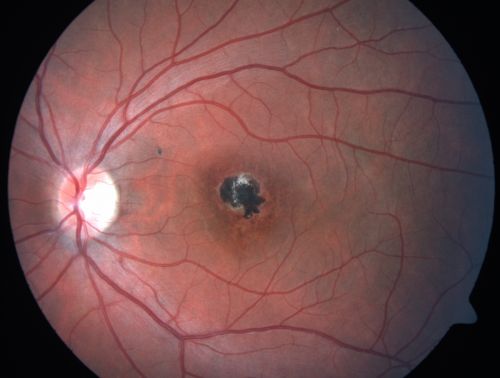 Toxoplasmosis Macular Scar (acquired not congenital) 31 Year Old Man- Recent Vision Change - Creeping Scar
31-year-old man had an episode of toxoplasmosis in the left eye, where unfortunately it adversely affected his central vision that was back in 2004 (7 years ago)
He did notice recently a change in his visual function.  He plays softball, he was getting hit by the ball and having trouble seeing and he said that is how he noticed the toxoplasmosis when it first occurred and he was concerned it might have recurred. 
OD 20/16,  OS 20/80. 
