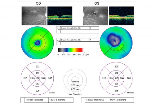 Toxoplasmosis Macular Scar (acquired not congenital) 31 Year Old Man- Recent Vision Change - Creeping Scar
31-year-old man had an episode of toxoplasmosis in the left eye, where unfortunately it adversely affected his central vision that was back in 2004 (7 years ago)
He did notice recently a change in his visual function.  He plays softball, he was getting hit by the ball and having trouble seeing and he said that is how he noticed the toxoplasmosis when it first occurred and he was concerned it might have recurred. 
OD 20/16,  OS 20/80. 
