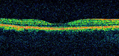 Toxoplasmosis Macular Scar (acquired not congenital) 31 Year Old Man- Recent Vision Change - Creeping Scar
31-year-old man had an episode of toxoplasmosis in the left eye, where unfortunately it adversely affected his central vision that was back in 2004 (7 years ago)
He did notice recently a change in his visual function.  He plays softball, he was getting hit by the ball and having trouble seeing and he said that is how he noticed the toxoplasmosis when it first occurred and he was concerned it might have recurred. 
OD 20/16,  OS 20/80. 
