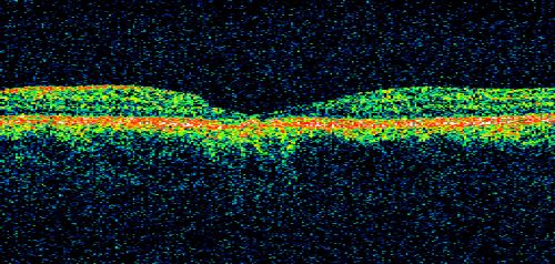 Toxoplasmosis Macular Scar (acquired not congenital) 31 Year Old Man- Recent Vision Change - Creeping Scar
31-year-old man had an episode of toxoplasmosis in the left eye, where unfortunately it adversely affected his central vision that was back in 2004 (7 years ago)
He did notice recently a change in his visual function.  He plays softball, he was getting hit by the ball and having trouble seeing and he said that is how he noticed the toxoplasmosis when it first occurred and he was concerned it might have recurred. 
OD 20/16,  OS 20/80. 
