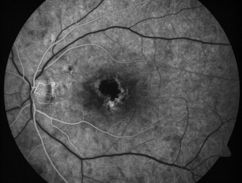 Toxoplasmosis Macular Scar (acquired not congenital) 31 Year Old Man- Recent Vision Change - Creeping Scar
31-year-old man had an episode of toxoplasmosis in the left eye, where unfortunately it adversely affected his central vision that was back in 2004 (7 years ago)
He did notice recently a change in his visual function.  He plays softball, he was getting hit by the ball and having trouble seeing and he said that is how he noticed the toxoplasmosis when it first occurred and he was concerned it might have recurred. 
OD 20/16,  OS 20/80. 

