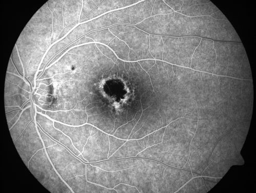 Toxoplasmosis Macular Scar (acquired not congenital) 31 Year Old Man- Recent Vision Change - Creeping Scar
31-year-old man had an episode of toxoplasmosis in the left eye, where unfortunately it adversely affected his central vision that was back in 2004 (7 years ago)
He did notice recently a change in his visual function.  He plays softball, he was getting hit by the ball and having trouble seeing and he said that is how he noticed the toxoplasmosis when it first occurred and he was concerned it might have recurred. 
OD 20/16,  OS 20/80. 
