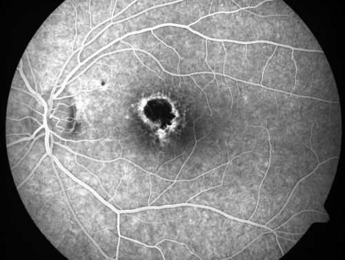 Toxoplasmosis Macular Scar (acquired not congenital) 31 Year Old Man- Recent Vision Change - Creeping Scar
31-year-old man had an episode of toxoplasmosis in the left eye, where unfortunately it adversely affected his central vision that was back in 2004 (7 years ago)
He did notice recently a change in his visual function.  He plays softball, he was getting hit by the ball and having trouble seeing and he said that is how he noticed the toxoplasmosis when it first occurred and he was concerned it might have recurred. 
OD 20/16,  OS 20/80. 
