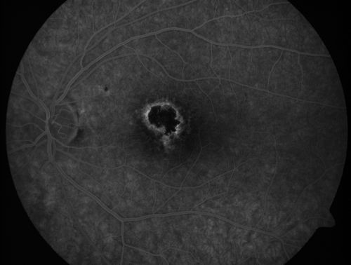 Toxoplasmosis Macular Scar (acquired not congenital) 31 Year Old Man- Recent Vision Change - Creeping Scar
31-year-old man had an episode of toxoplasmosis in the left eye, where unfortunately it adversely affected his central vision that was back in 2004 (7 years ago)
He did notice recently a change in his visual function.  He plays softball, he was getting hit by the ball and having trouble seeing and he said that is how he noticed the toxoplasmosis when it first occurred and he was concerned it might have recurred. 
OD 20/16,  OS 20/80. 
