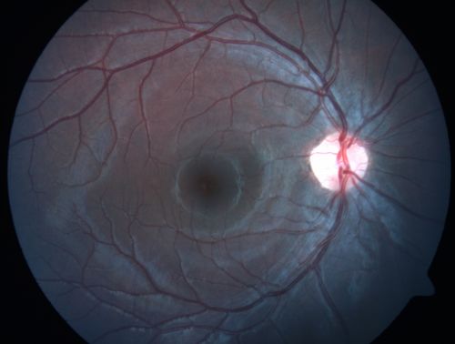 Macular Hole - Traumatic - 11 year old boy (also retinal whitening Berlins Edema)
11-year-old boy with a history of blunt trauma to the left eye yesterday.  He reports he lost vision immediately but it has gotten somewhat better.  He reports he sees â€œred streamersâ€ and he has very blurry visual acuity., 20/200 OS
