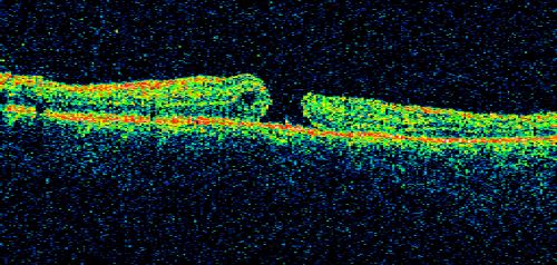 Macular Hole - Traumatic - 11 year old boy (also retinal whitening Berlins Edema)
11-year-old boy with a history of blunt trauma to the left eye yesterday.  He reports he lost vision immediately but it has gotten somewhat better.  He reports he sees â€œred streamersâ€ and he has very blurry visual acuity., 20/200 OS
 1 week post injury and 1 month later (not shown here) mature full thickness macular hole.
