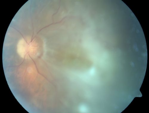 Chronic Macula-off Tractional Retinal Detachment Left Eye Proliferative Diabetic Retinopathy
81-year-old man with diabetes for 24 years has proliferative diabetic retinopathy in both eyes with a chronic tractional retinal detachment in the left eye 4 years old. OD is 20/40, OS is 2/200
