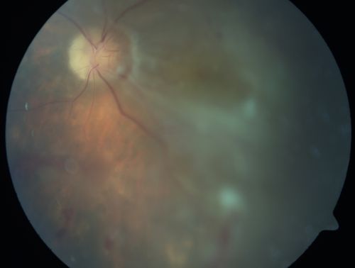 Chronic Macula-off Tractional Retinal Detachment Left Eye Proliferative Diabetic Retinopathy
81-year-old man with diabetes for 24 years has proliferative diabetic retinopathy in both eyes with a chronic tractional retinal detachment in the left eye 4 years old. OD is 20/40, OS is 2/200
