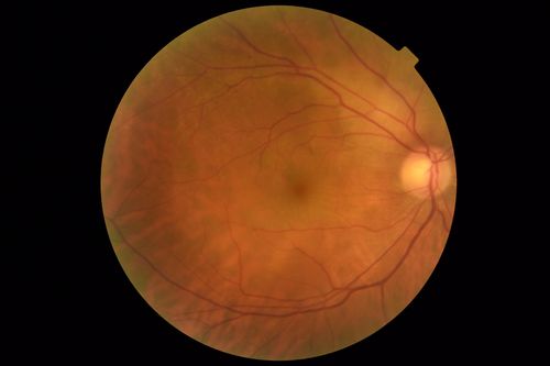 Lung Cancer Metastasis to Right Eye
63 year old female with vision loss for 6 weeks.  She had been scheduled for cataract surgery and then a tumor was found.  She was ultimately diagnosed with lung cancer.  Vision is 20/100
