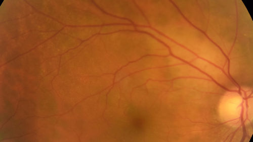 Lung Cancer Metastasis to Right Eye
63 year old female with vision loss for 6 weeks.  She had been scheduled for cataract surgery and then a tumor was found.  She was ultimately diagnosed with lung cancer.  Vision is 20/100
