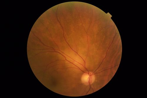 Lung Cancer Metastasis to Right Eye
63 year old female with vision loss for 6 weeks.  She had been scheduled for cataract surgery and then a tumor was found.  She was ultimately diagnosed with lung cancer.  Vision is 20/100
