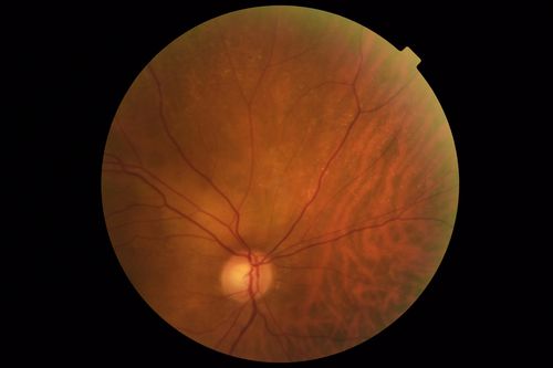 Lung Cancer Metastasis to Right Eye
63 year old female with vision loss for 6 weeks.  She had been scheduled for cataract surgery and then a tumor was found.  She was ultimately diagnosed with lung cancer.  Vision is 20/100
