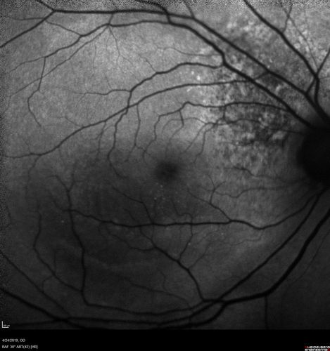 Lung Cancer Metastasis to Right Eye
63 year old female with vision loss for 6 weeks.  She had been scheduled for cataract surgery and then a tumor was found.  She was ultimately diagnosed with lung cancer.  Vision is 20/100
