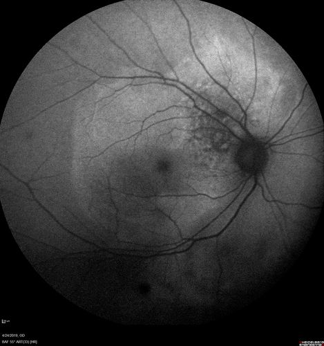 Lung Cancer Metastasis to Right Eye
63 year old female with vision loss for 6 weeks.  She had been scheduled for cataract surgery and then a tumor was found.  She was ultimately diagnosed with lung cancer.  Vision is 20/100
