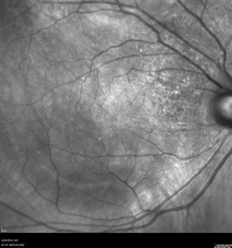 Lung Cancer Metastasis to Right Eye
63 year old female with vision loss for 6 weeks.  She had been scheduled for cataract surgery and then a tumor was found.  She was ultimately diagnosed with lung cancer.  Vision is 20/100
