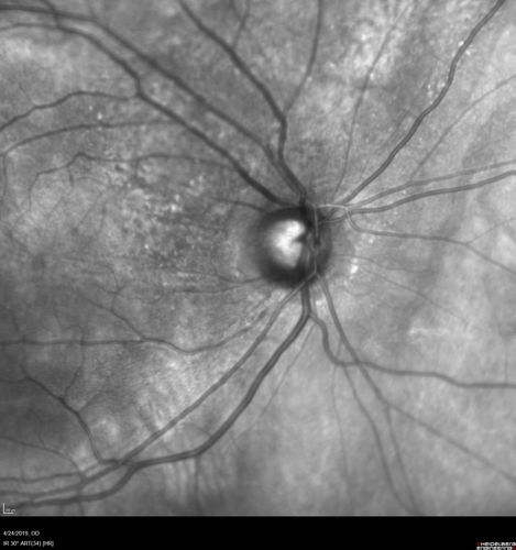 Lung Cancer Metastasis to Right Eye
63 year old female with vision loss for 6 weeks.  She had been scheduled for cataract surgery and then a tumor was found.  She was ultimately diagnosed with lung cancer.  Vision is 20/100
