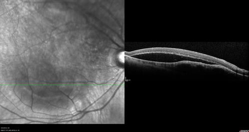 Lung Cancer Metastasis to Right Eye
63 year old female with vision loss for 6 weeks.  She had been scheduled for cataract surgery and then a tumor was found.  She was ultimately diagnosed with lung cancer.  Vision is 20/100
