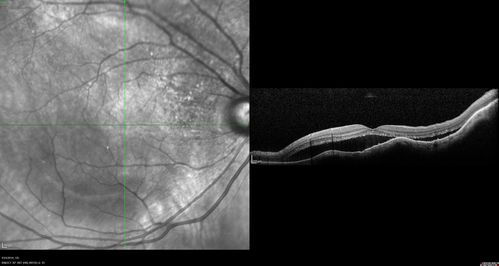 Lung Cancer Metastasis to Right Eye
63 year old female with vision loss for 6 weeks.  She had been scheduled for cataract surgery and then a tumor was found.  She was ultimately diagnosed with lung cancer.  Vision is 20/100
