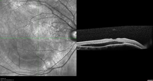 Lung Cancer Metastasis to Right Eye
63 year old female with vision loss for 6 weeks.  She had been scheduled for cataract surgery and then a tumor was found.  She was ultimately diagnosed with lung cancer.  Vision is 20/100
