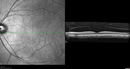 Lung Cancer Metastasis to Right Eye
63 year old female with vision loss for 6 weeks.  She had been scheduled for cataract surgery and then a tumor was found.  She was ultimately diagnosed with lung cancer.  Vision is 20/100
