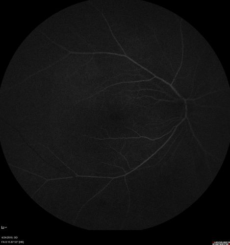 Lung Cancer Metastasis to Right Eye
63 year old female with vision loss for 6 weeks.  She had been scheduled for cataract surgery and then a tumor was found.  She was ultimately diagnosed with lung cancer.  Vision is 20/100
