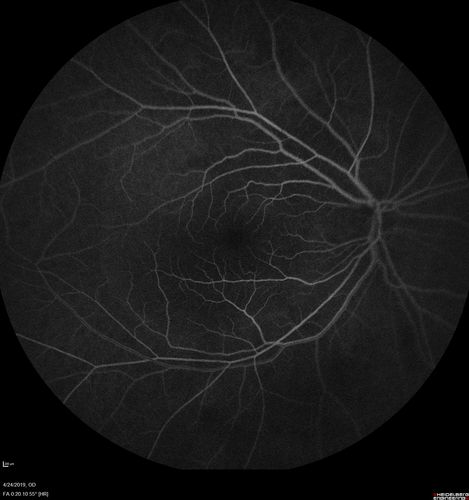 Lung Cancer Metastasis to Right Eye
63 year old female with vision loss for 6 weeks.  She had been scheduled for cataract surgery and then a tumor was found.  She was ultimately diagnosed with lung cancer.  Vision is 20/100
