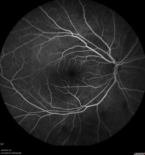 Lung Cancer Metastasis to Right Eye
63 year old female with vision loss for 6 weeks.  She had been scheduled for cataract surgery and then a tumor was found.  She was ultimately diagnosed with lung cancer.  Vision is 20/100
