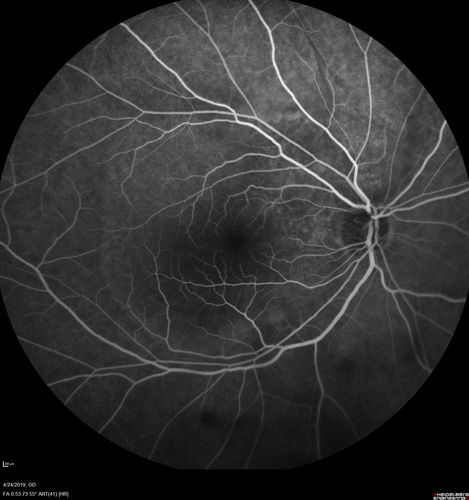 Lung Cancer Metastasis to Right Eye
63 year old female with vision loss for 6 weeks.  She had been scheduled for cataract surgery and then a tumor was found.  She was ultimately diagnosed with lung cancer.  Vision is 20/100
