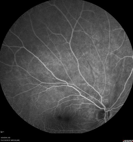 Lung Cancer Metastasis to Right Eye
63 year old female with vision loss for 6 weeks.  She had been scheduled for cataract surgery and then a tumor was found.  She was ultimately diagnosed with lung cancer.  Vision is 20/100
