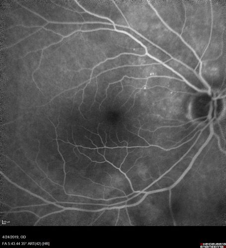 Lung Cancer Metastasis to Right Eye
63 year old female with vision loss for 6 weeks.  She had been scheduled for cataract surgery and then a tumor was found.  She was ultimately diagnosed with lung cancer.  Vision is 20/100
