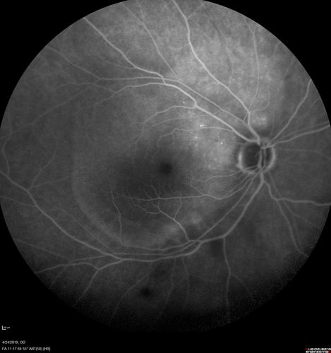 Lung Cancer Metastasis to Right Eye
63 year old female with vision loss for 6 weeks.  She had been scheduled for cataract surgery and then a tumor was found.  She was ultimately diagnosed with lung cancer.  Vision is 20/100
