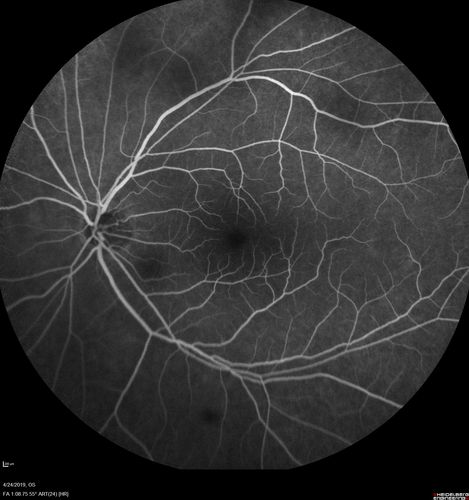 Lung Cancer Metastasis to Right Eye
63 year old female with vision loss for 6 weeks.  She had been scheduled for cataract surgery and then a tumor was found.  She was ultimately diagnosed with lung cancer.  Vision is 20/100
