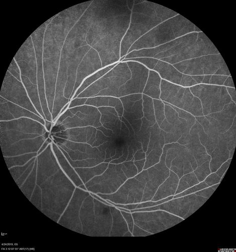 Lung Cancer Metastasis to Right Eye
63 year old female with vision loss for 6 weeks.  She had been scheduled for cataract surgery and then a tumor was found.  She was ultimately diagnosed with lung cancer.  Vision is 20/100
