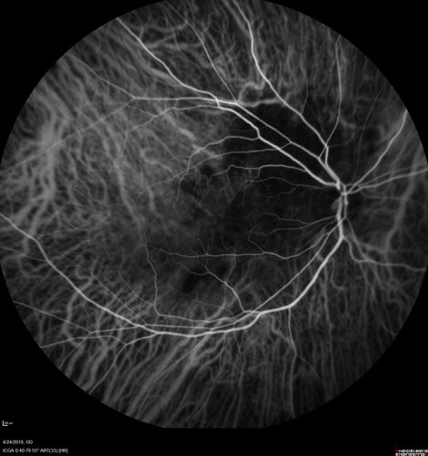 Lung Cancer Metastasis to Right Eye
63 year old female with vision loss for 6 weeks.  She had been scheduled for cataract surgery and then a tumor was found.  She was ultimately diagnosed with lung cancer.  Vision is 20/100

