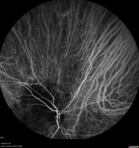 Lung Cancer Metastasis to Right Eye
63 year old female with vision loss for 6 weeks.  She had been scheduled for cataract surgery and then a tumor was found.  She was ultimately diagnosed with lung cancer.  Vision is 20/100
