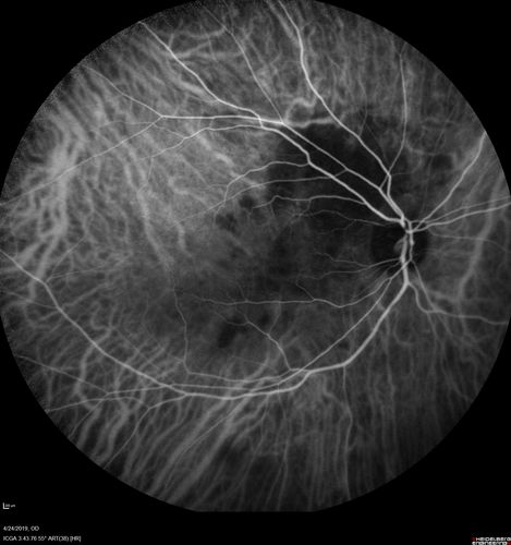 Lung Cancer Metastasis to Right Eye
63 year old female with vision loss for 6 weeks.  She had been scheduled for cataract surgery and then a tumor was found.  She was ultimately diagnosed with lung cancer.  Vision is 20/100
