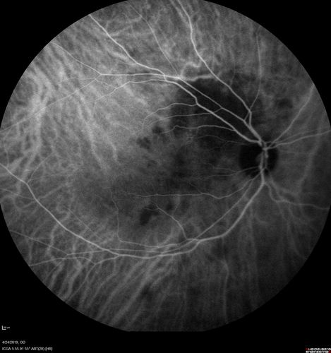 Lung Cancer Metastasis to Right Eye
63 year old female with vision loss for 6 weeks.  She had been scheduled for cataract surgery and then a tumor was found.  She was ultimately diagnosed with lung cancer.  Vision is 20/100
