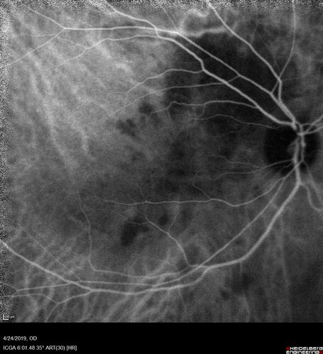 Lung Cancer Metastasis to Right Eye
63 year old female with vision loss for 6 weeks.  She had been scheduled for cataract surgery and then a tumor was found.  She was ultimately diagnosed with lung cancer.  Vision is 20/100
