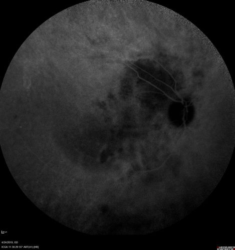 Lung Cancer Metastasis to Right Eye
63 year old female with vision loss for 6 weeks.  She had been scheduled for cataract surgery and then a tumor was found.  She was ultimately diagnosed with lung cancer.  Vision is 20/100
