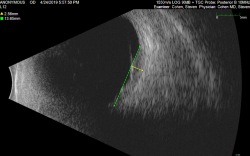 Lung Cancer Metastasis to Right Eye
63 year old female with vision loss for 6 weeks.  She had been scheduled for cataract surgery and then a tumor was found.  She was ultimately diagnosed with lung cancer.  Vision is 20/100
