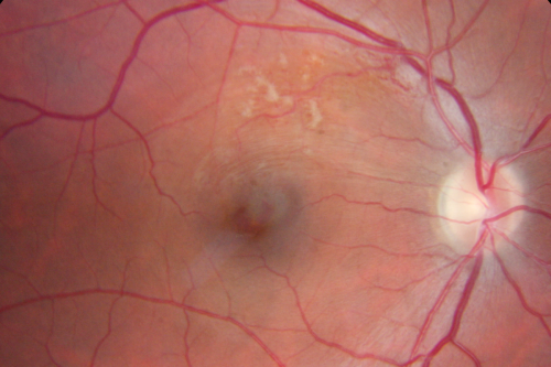 Twig Branch Retinal Vein Occlusion - Recurrent Macular Edema with extended interval Lucentis Therapy after first 6 monthly Injections
39-year-old man has a macular branch retinal vein occlusion with macular edema.  He had an excellent response to Lucentis for his first 6 treatments.  He was last here 6 weeks ago and his vision seems OK to him.  OD 20/40. 

